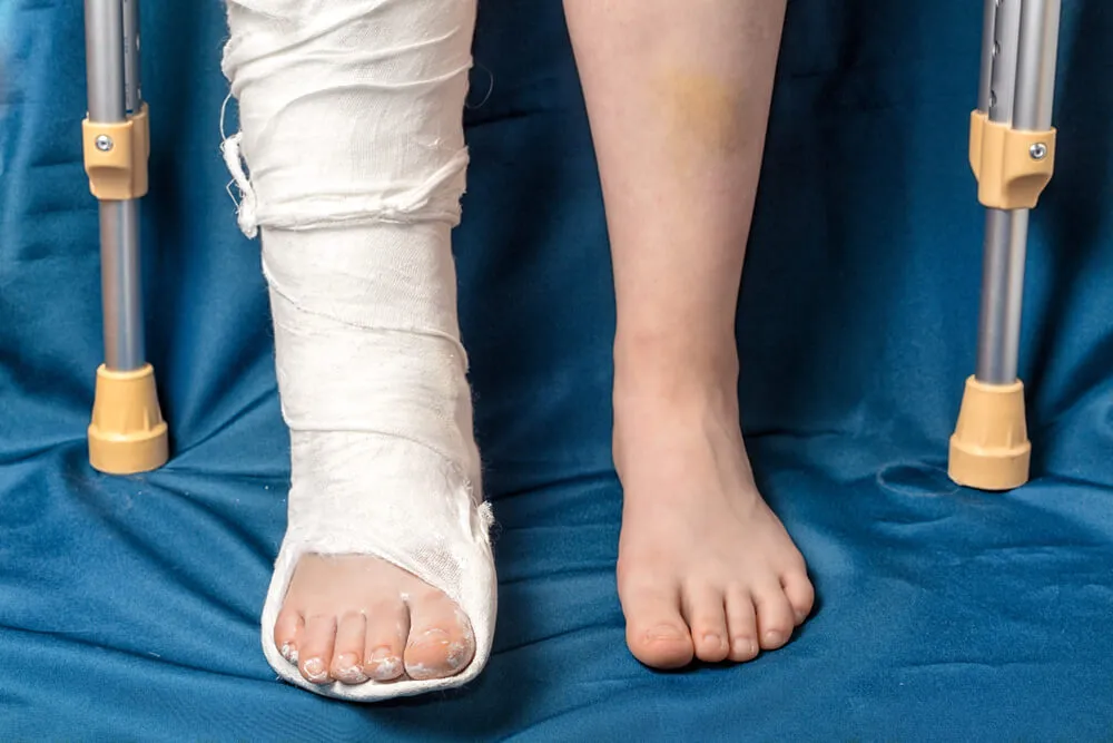 will they let you on a plane with a cast